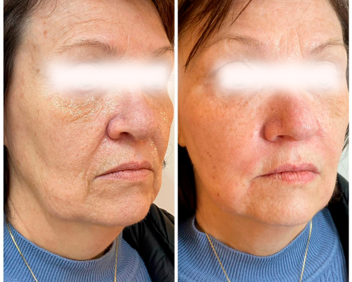 Bioestimulo de colágeno