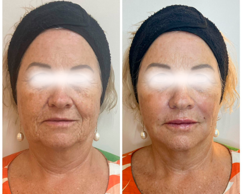 Bioestimulo de colágeno