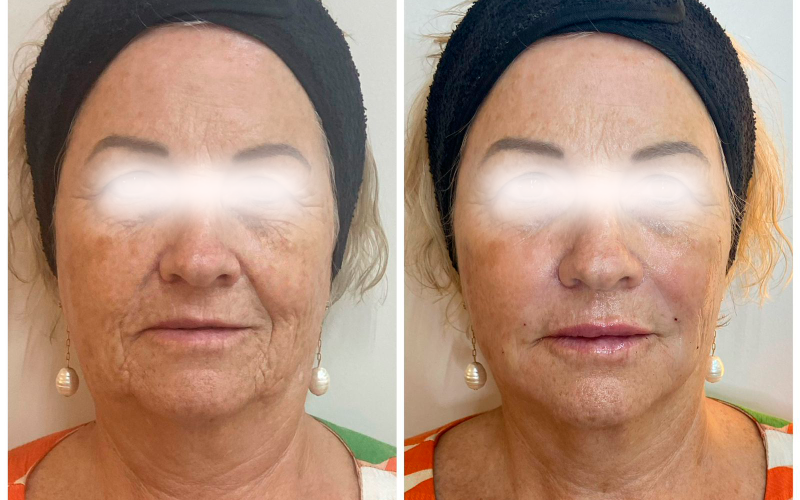 Bioestimulo de colágeno