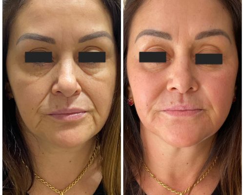 Bioestimulo de colágeno